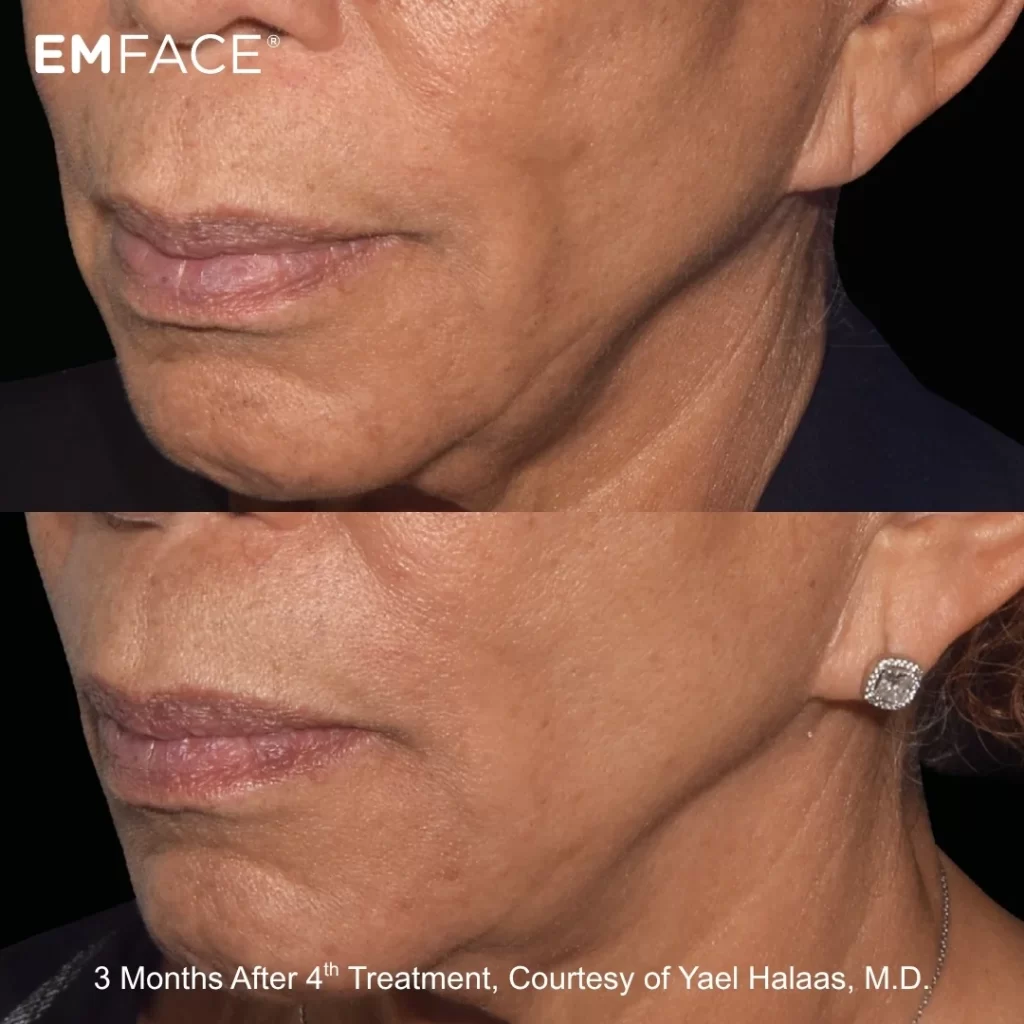EmFace before-and-after results — cheeks (female patient)