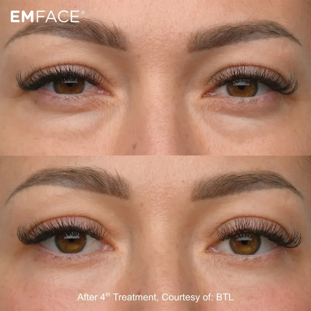 EmFace before-and-after results — eye area (female patient)