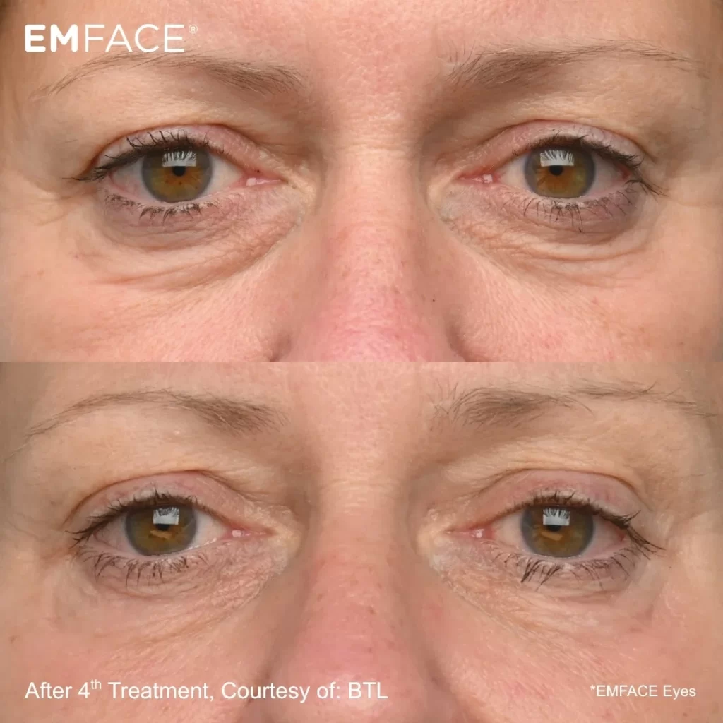 EmFace before-and-after results — eye area (female patient)