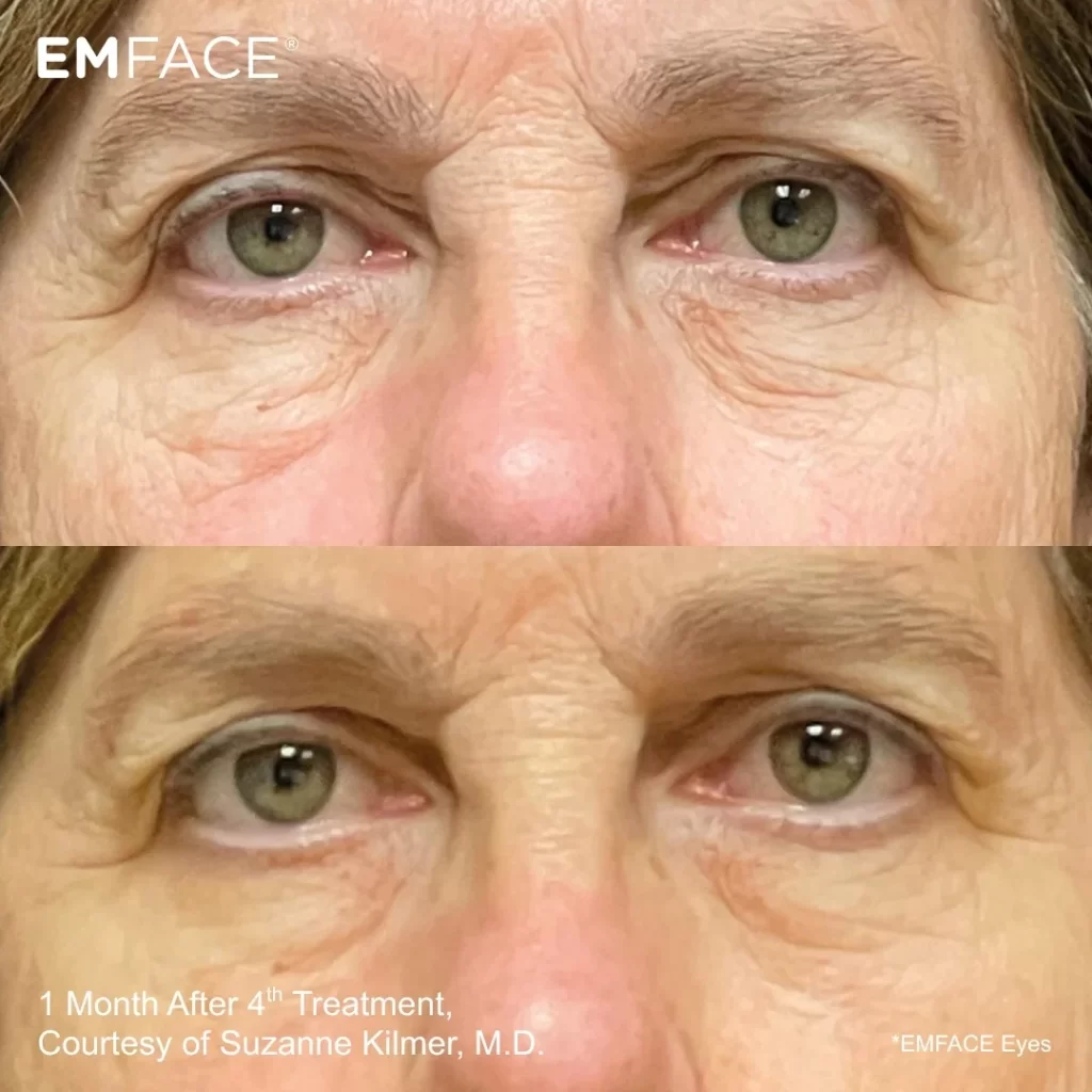 EmFace before-and-after results — eye area (female patient)