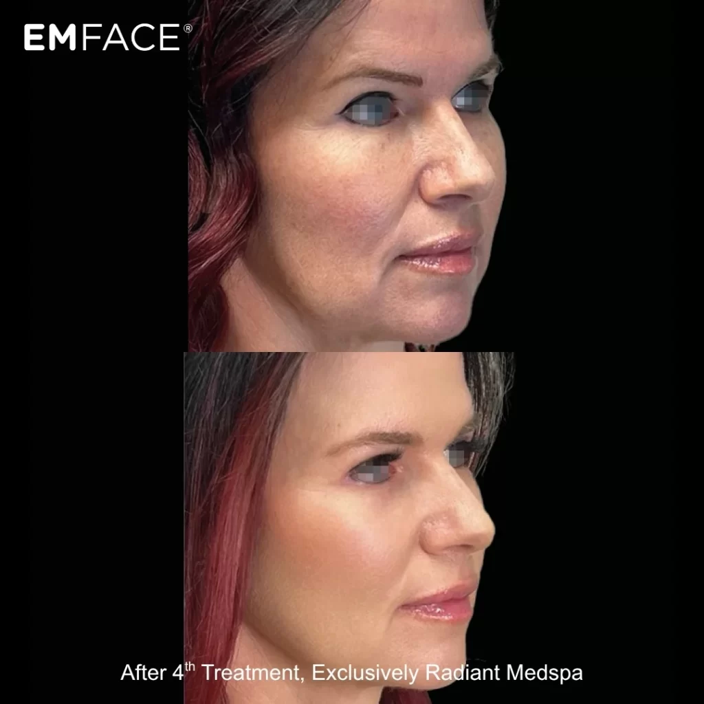 EmFace before-and-after results — full face (female patient)