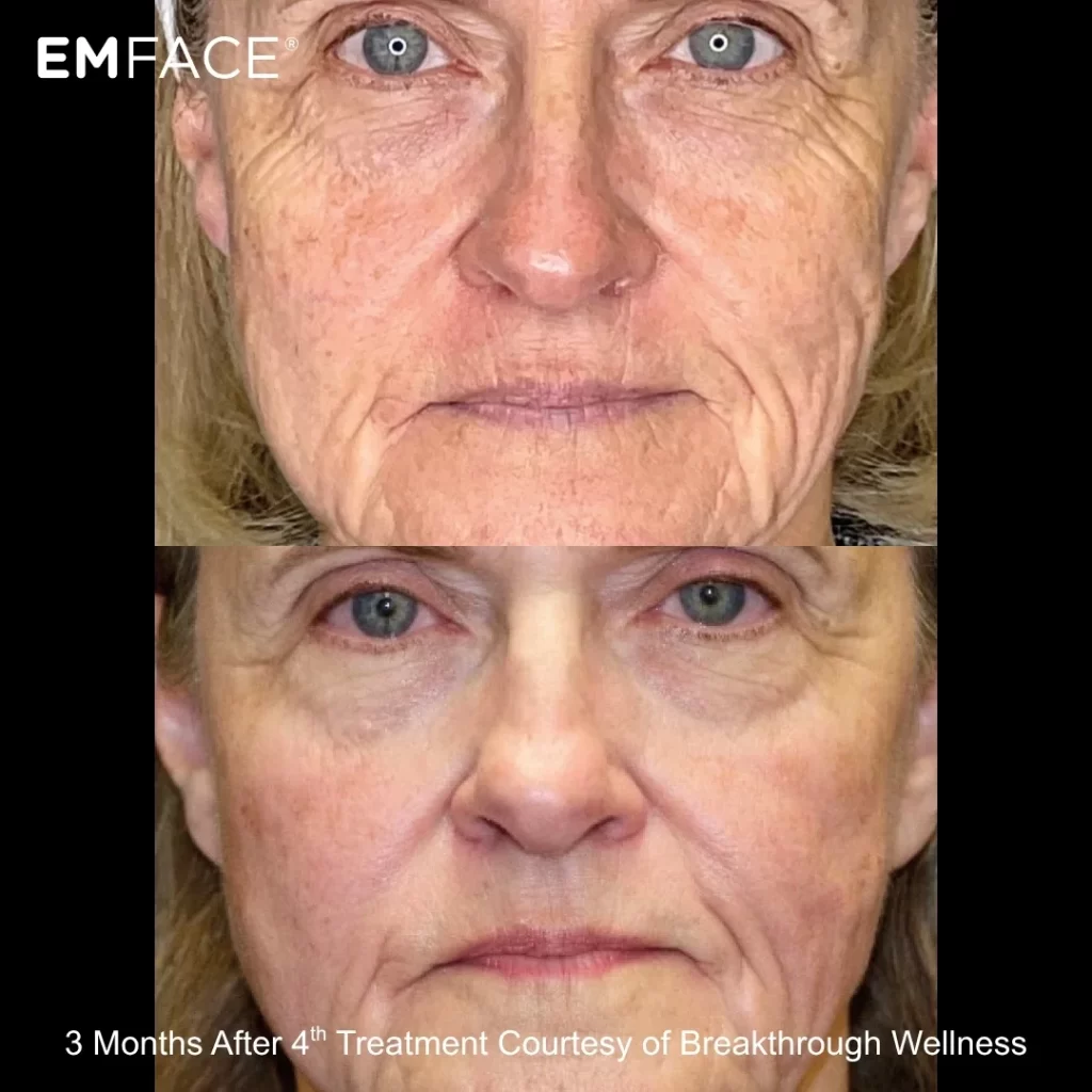 EmFace before-and-after results — full face (female patient)