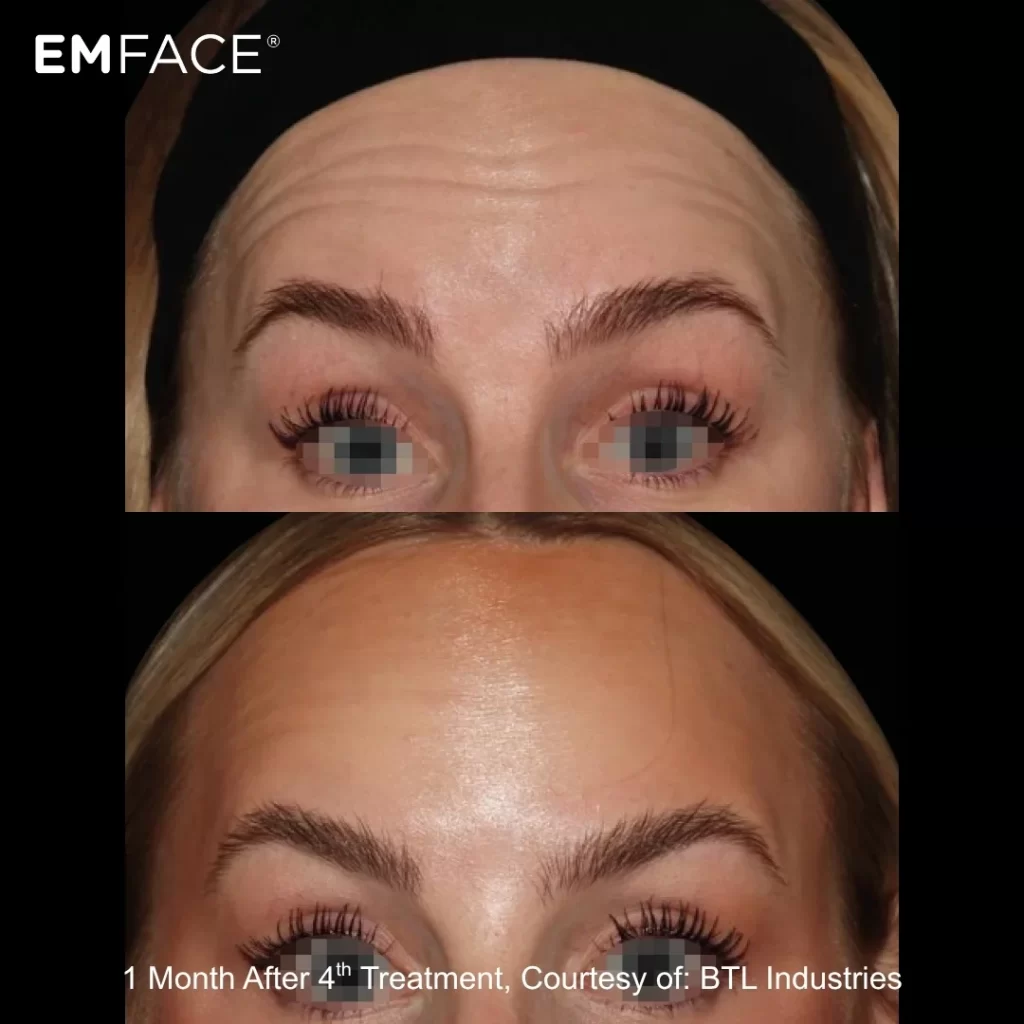 EmFace before-and-after results — forehead (female patient)