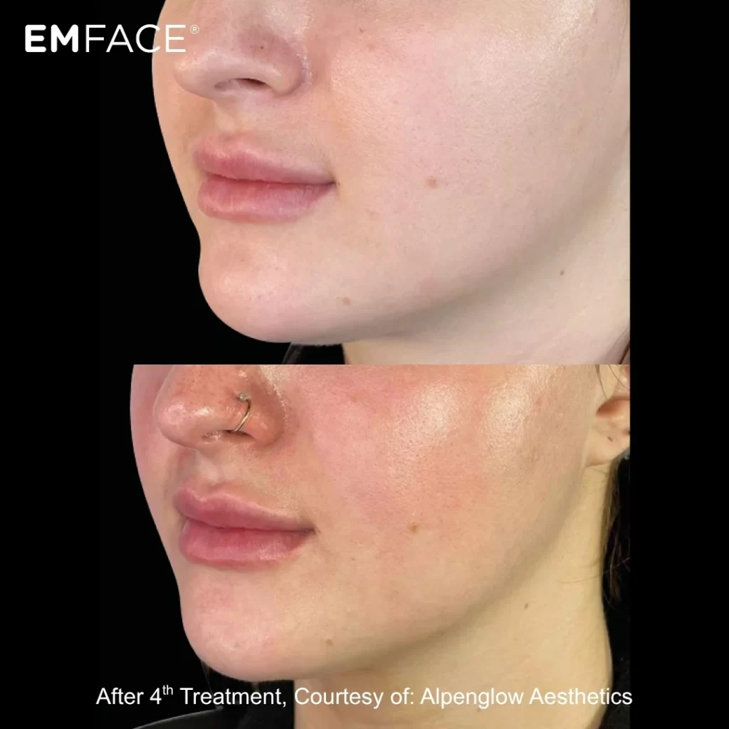 EmFace before-and-after results — jawline (female patient)