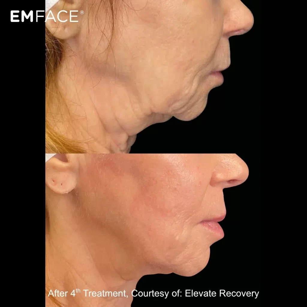 EmFace before-and-after results — jawline (female patient)