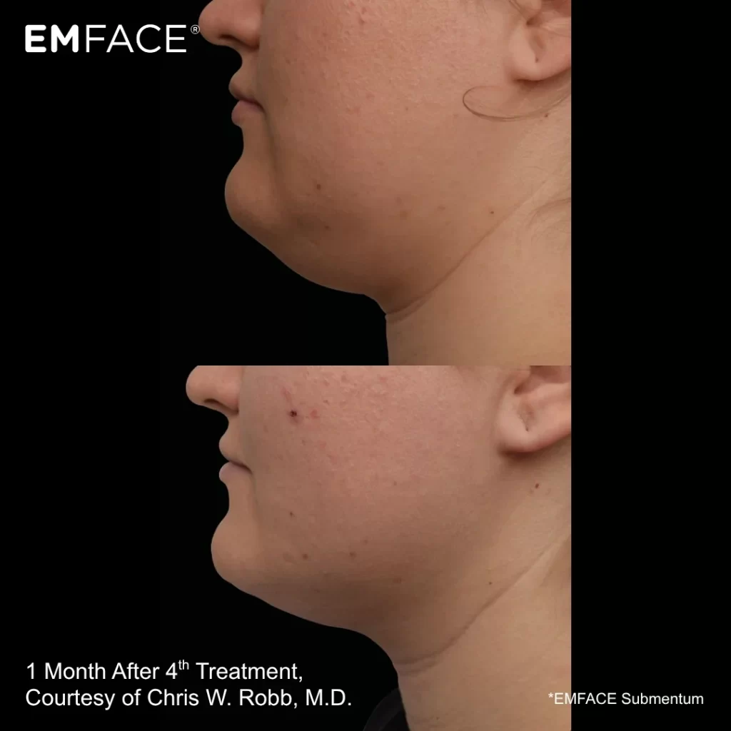 EmFace before-and-after results — under-chin (submental) (female patient)