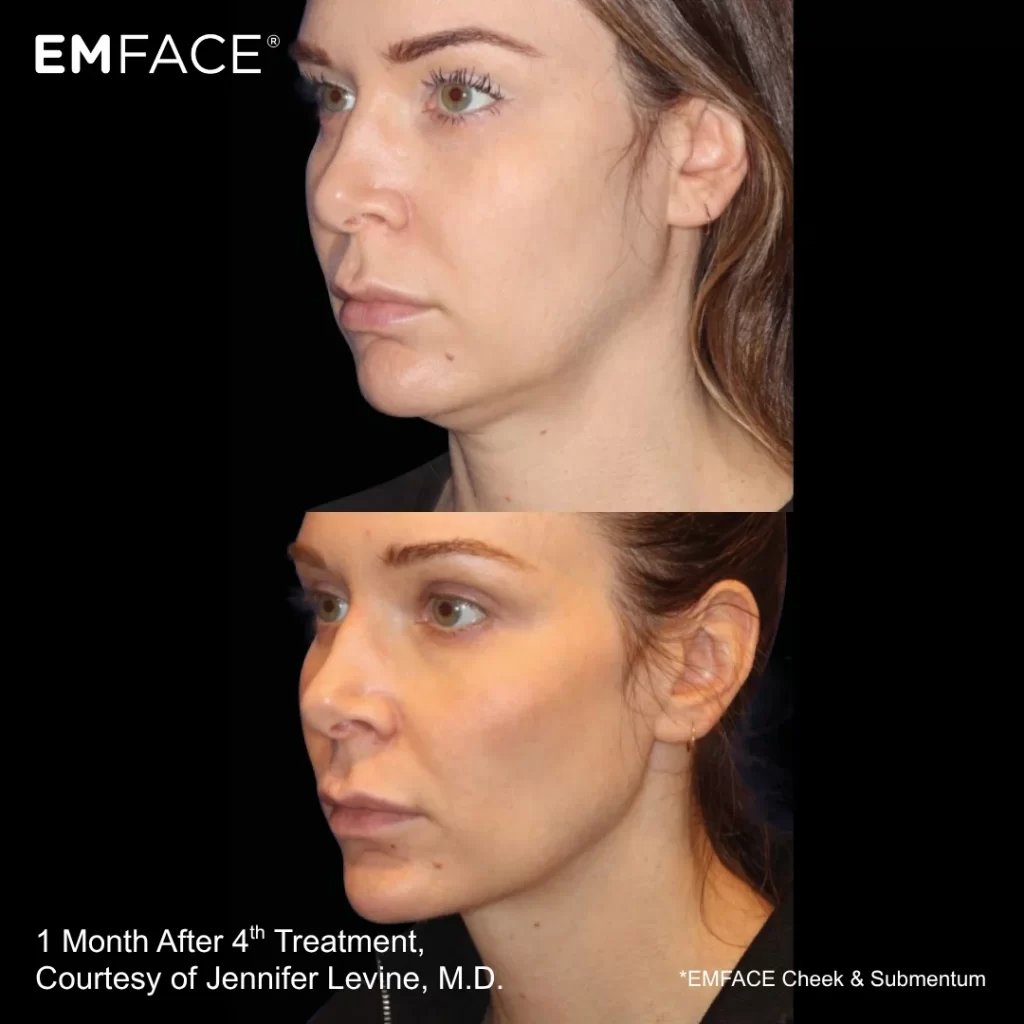 EmFace before-and-after results — under-chin (submental) (female patient)