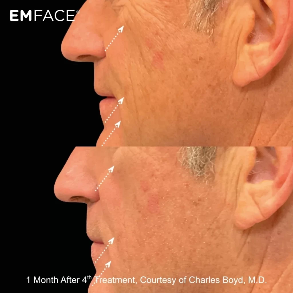 EmFace before-and-after results — cheeks (male patient)