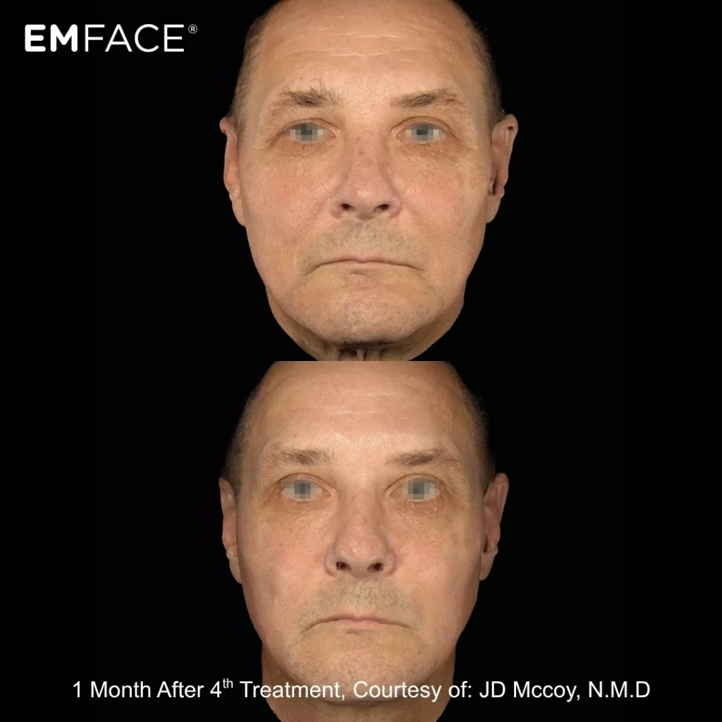 EmFace before-and-after results — full face (male patient)