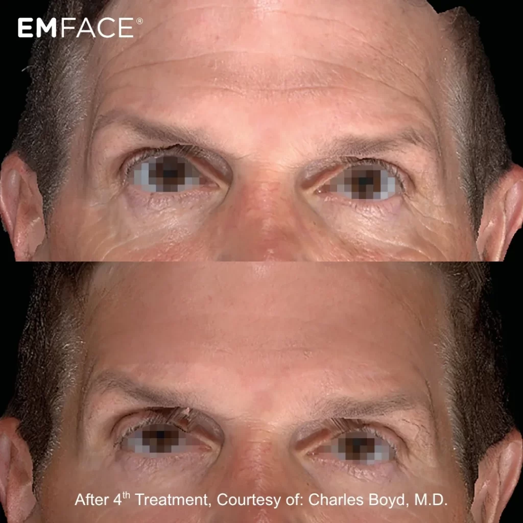 EmFace before-and-after results — forehead (male patient)