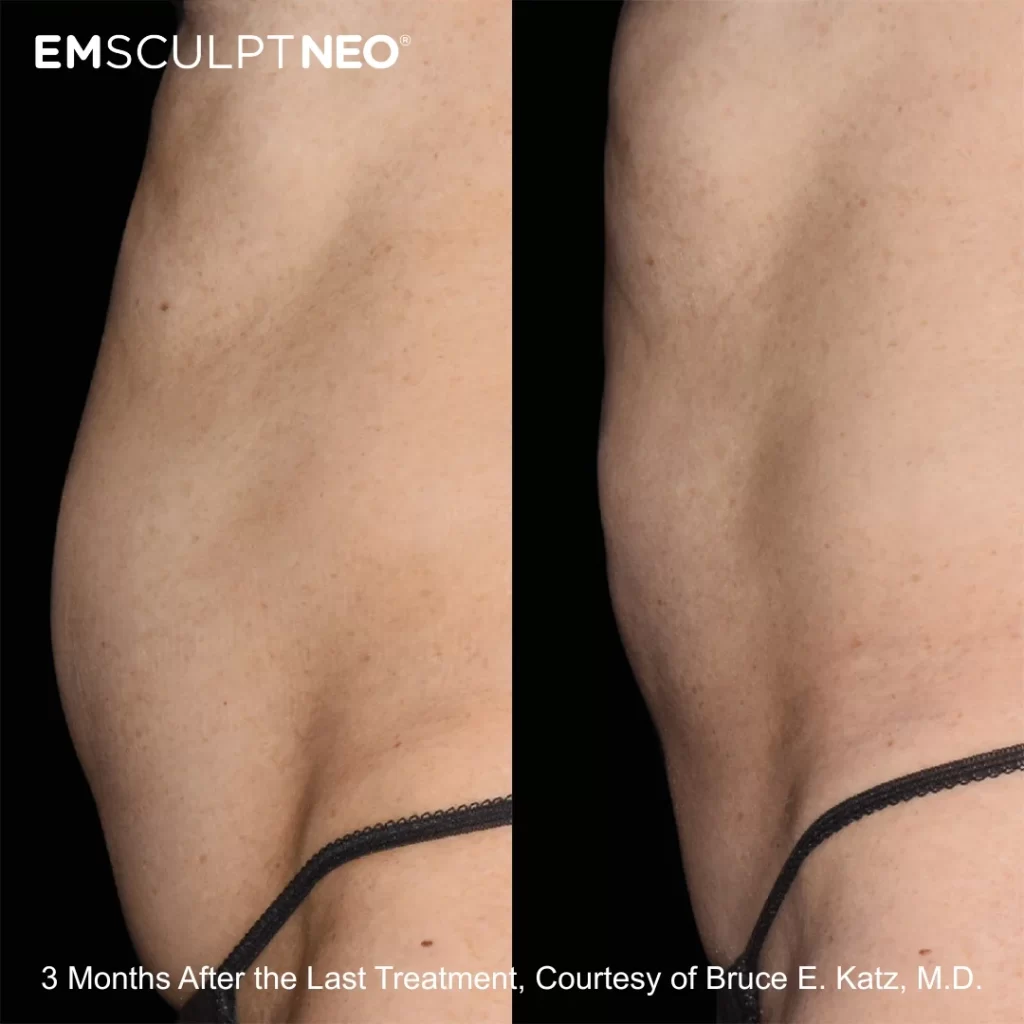 Emsculpt before-and-after results on the abdomen (female patient)