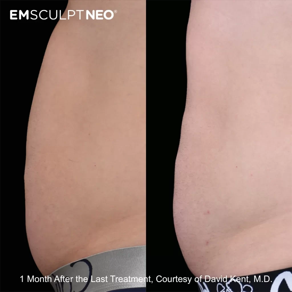 Emsculpt before-and-after results on the abdomen (male patient)
