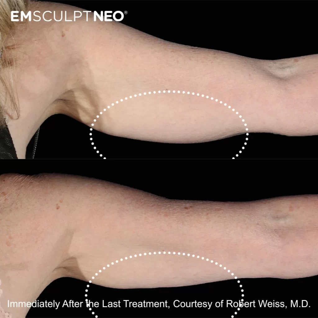 Emsculpt NEO before-and-after results — arms (female patient)