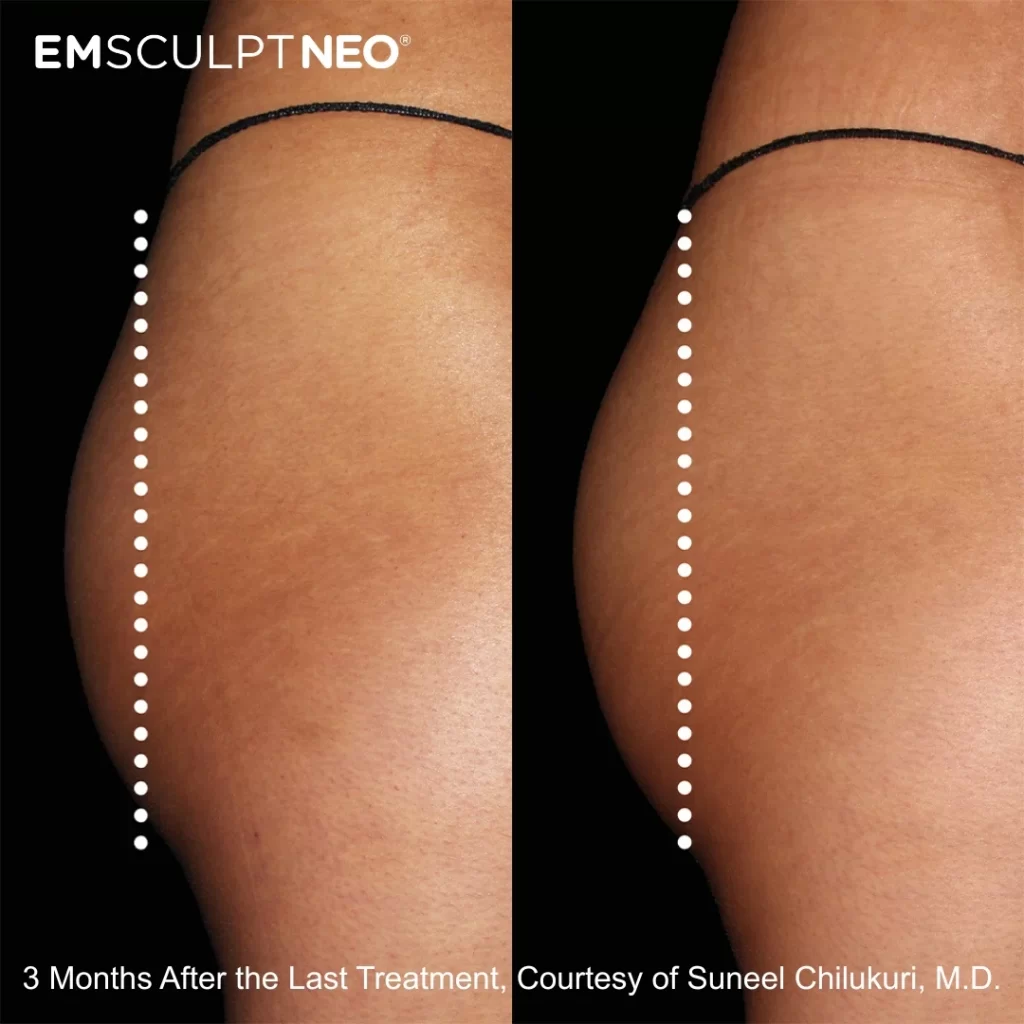 Emsculpt NEO before-and-after results — buttocks (female patient)