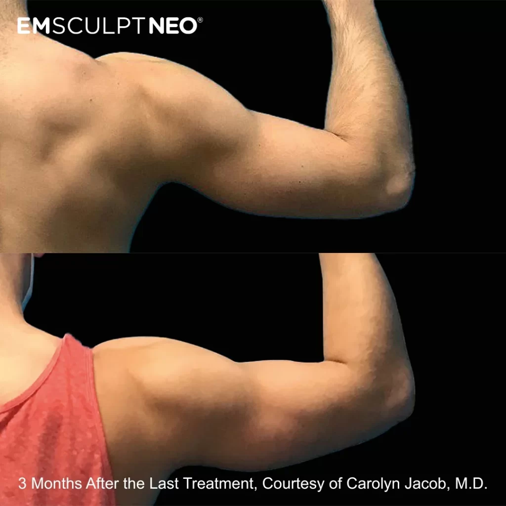 Emsculpt NEO before-and-after results — arms (male patient)