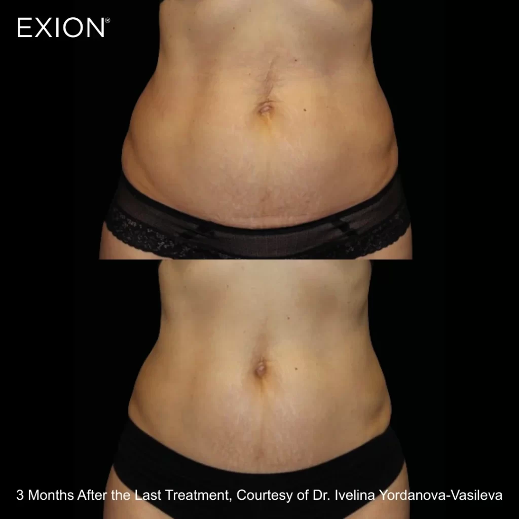 Exion before-and-after results — abdomen (female patient)