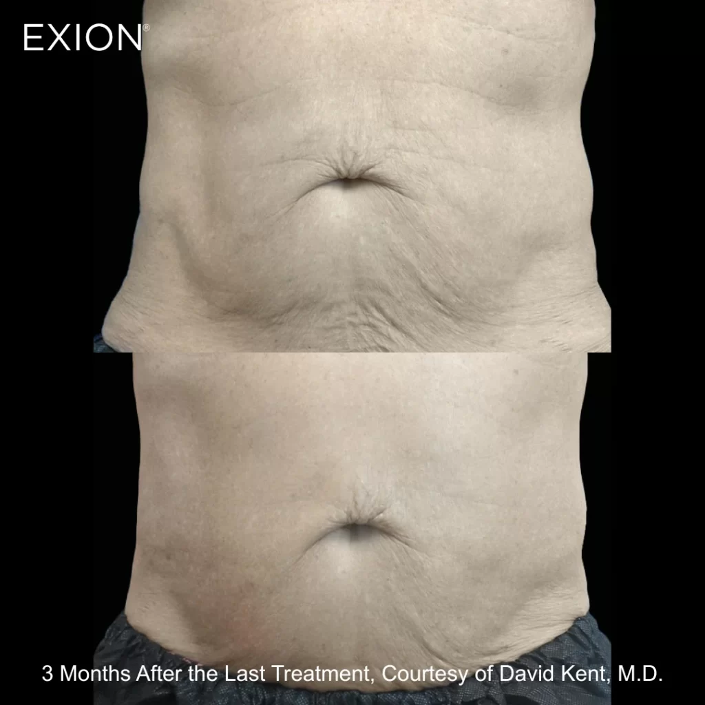Exion before-and-after results — abdomen (male patient)