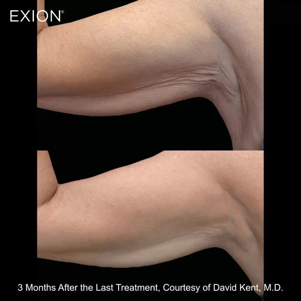 Exion before-and-after results — arms (female patient)