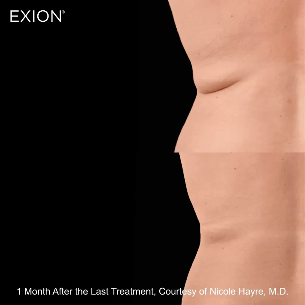 Exion before-and-after results — back (female patient)