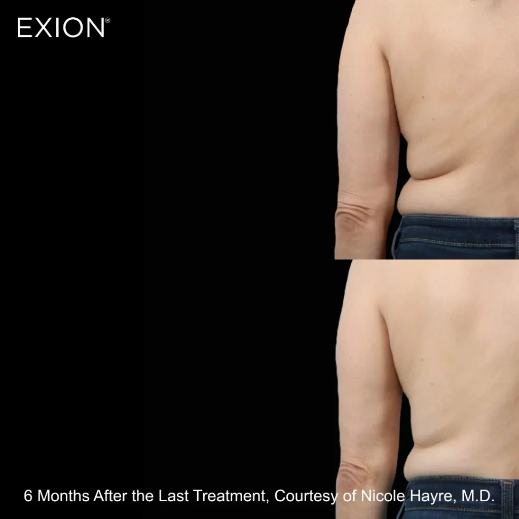 Exion before-and-after results — back (female patient)