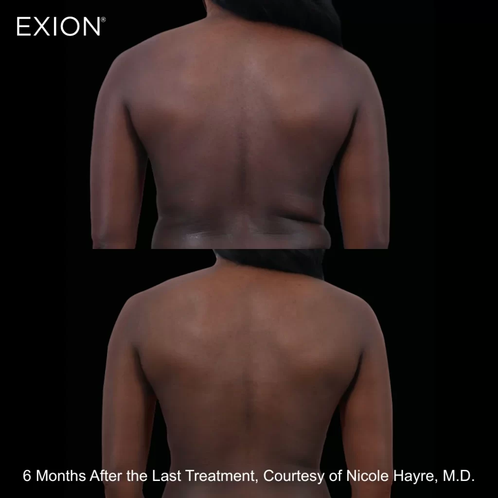 Exion before-and-after results — back (female patient)