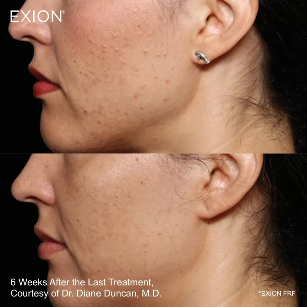 Exion before-and-after results — cheeks (female patient)