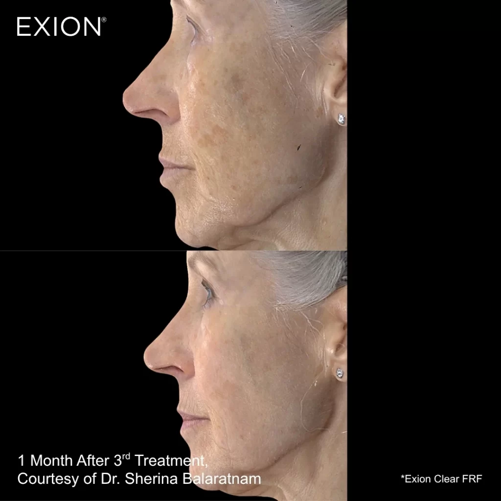 Exion before-and-after results — cheeks (female patient)