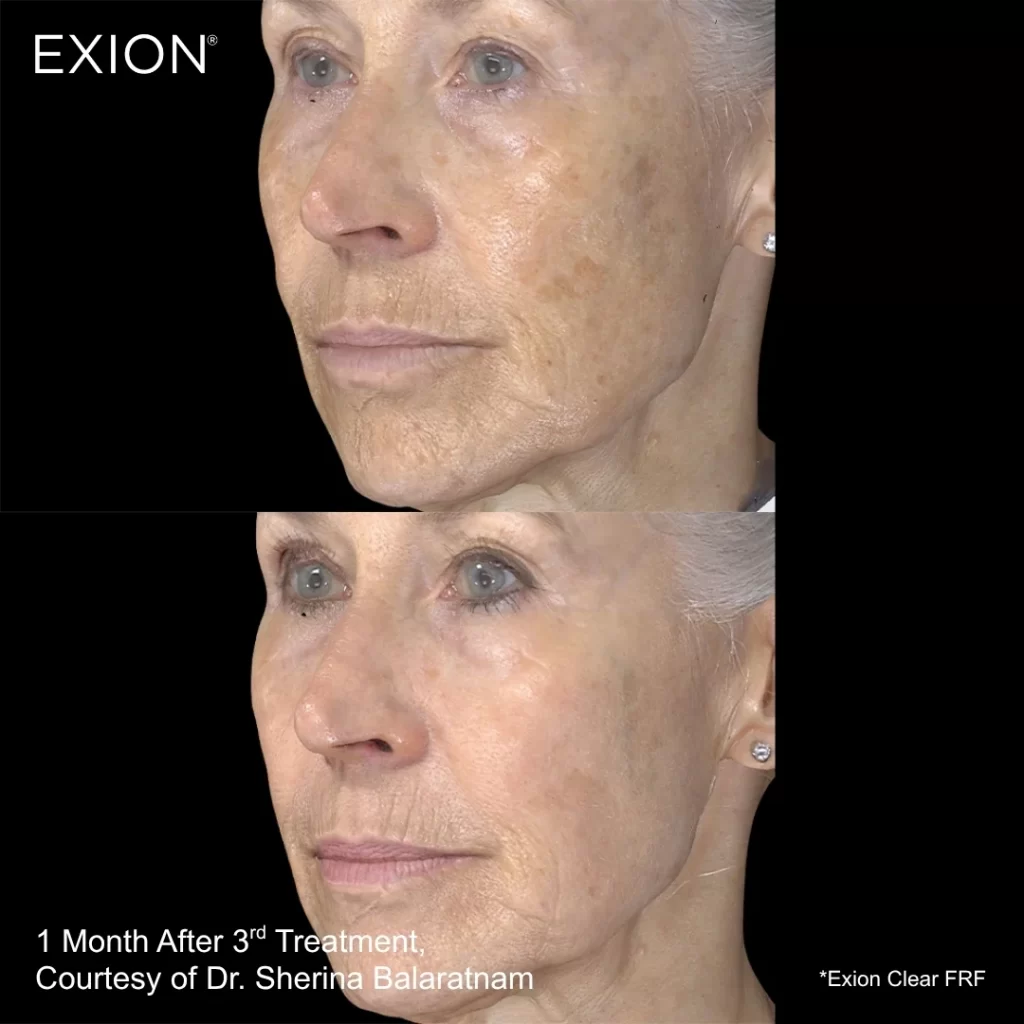 Exion before-and-after results — cheeks (female patient)