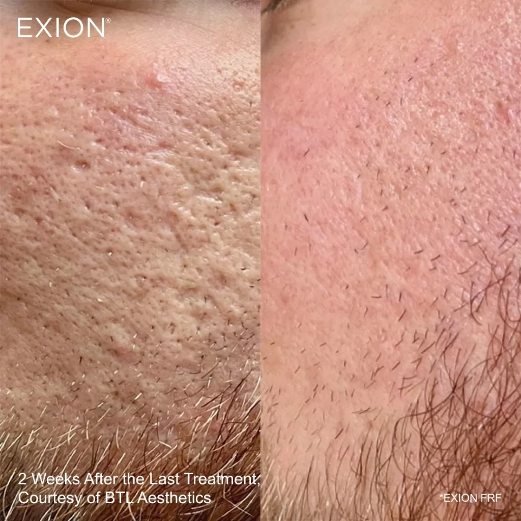 Exion before-and-after results — cheeks (male patient)