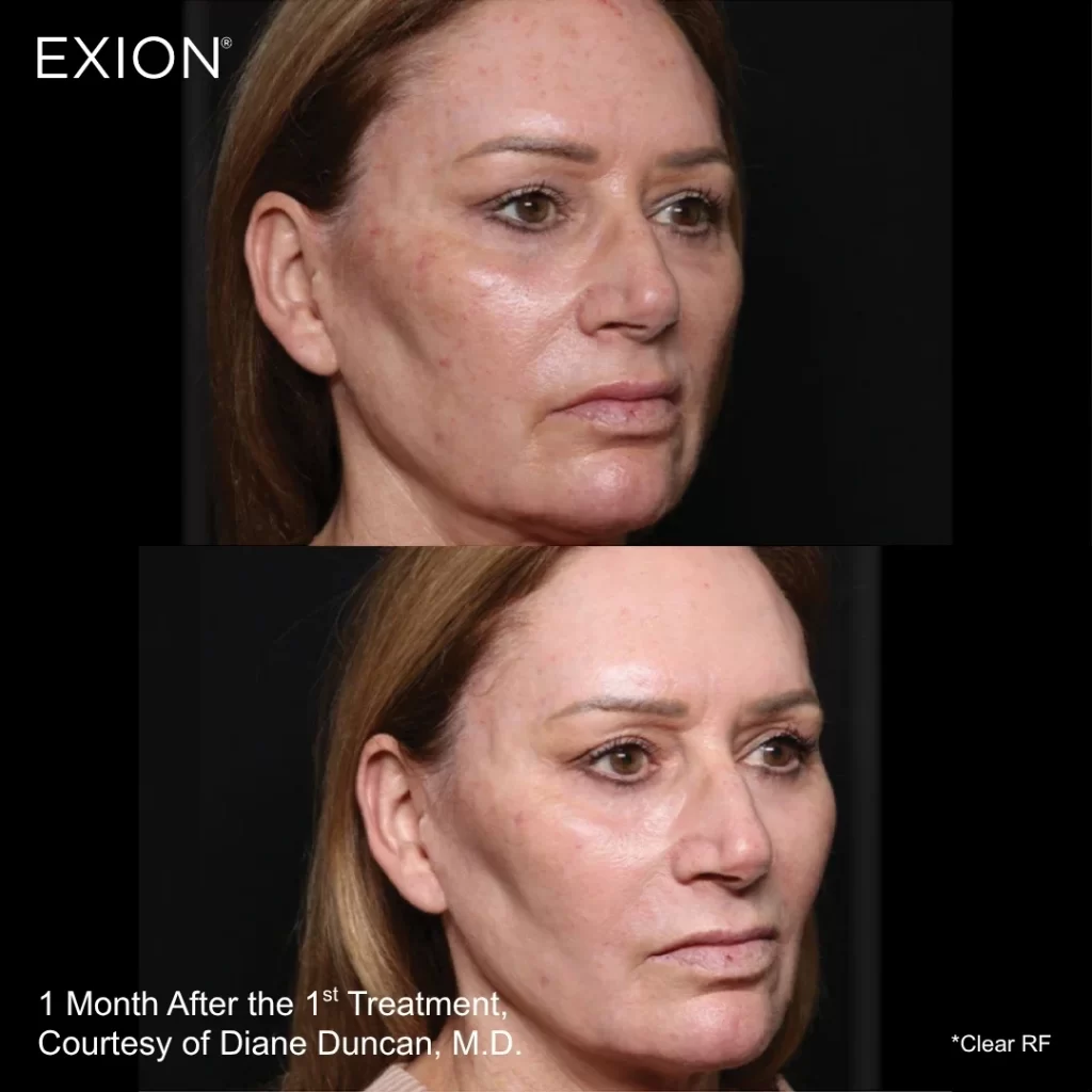 Exion before-and-after results — full face (female patient)