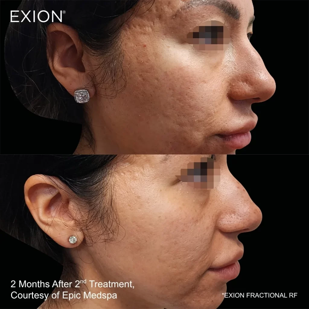Exion before-and-after results — full face (female patient)