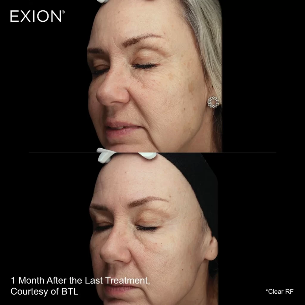 Exion before-and-after results — full face (female patient)