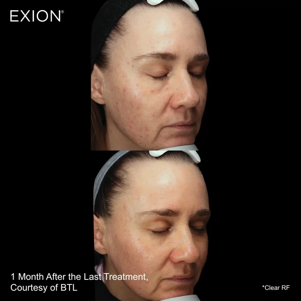 Exion before-and-after results — full face (female patient)