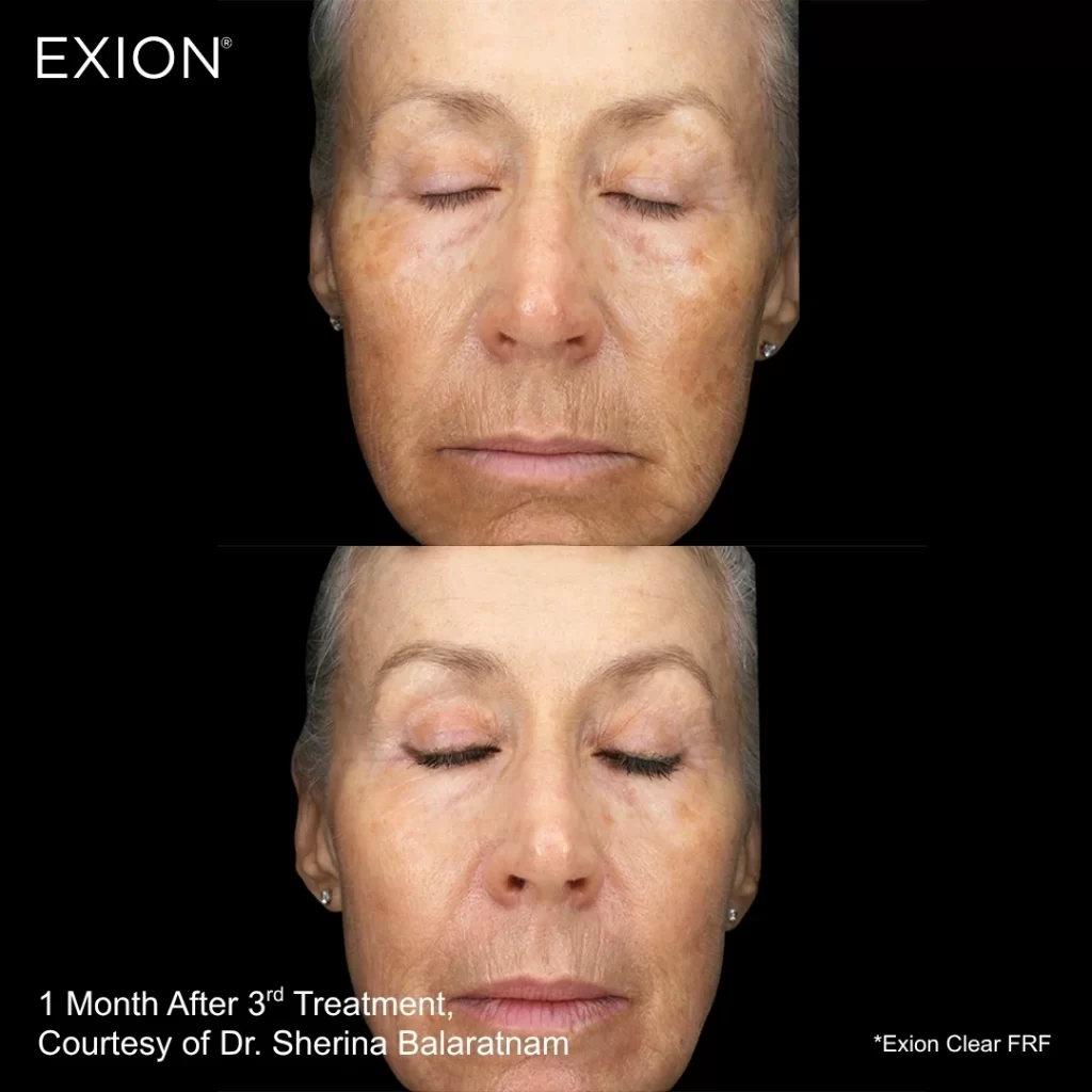 Exion before-and-after results — full face (female patient)