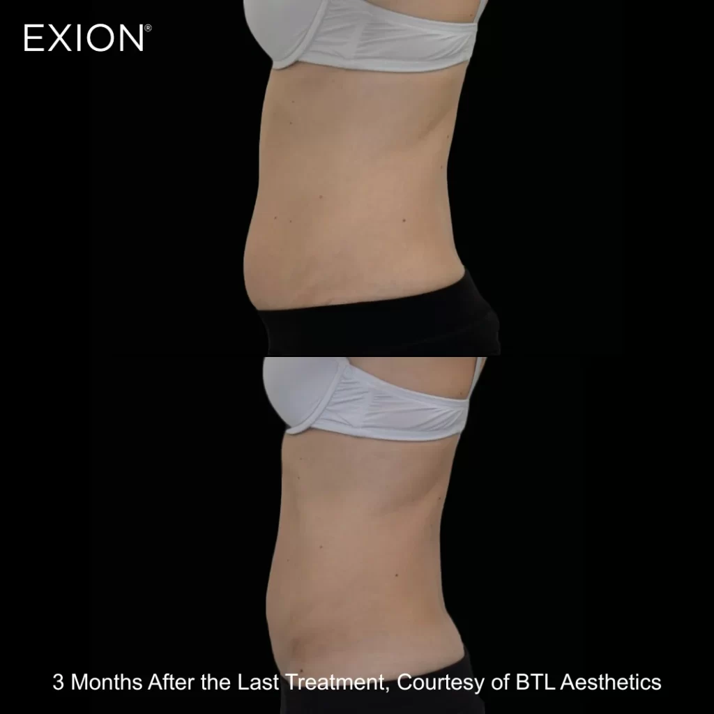 Exion before-and-after results — abdomen (side view) (female patient)