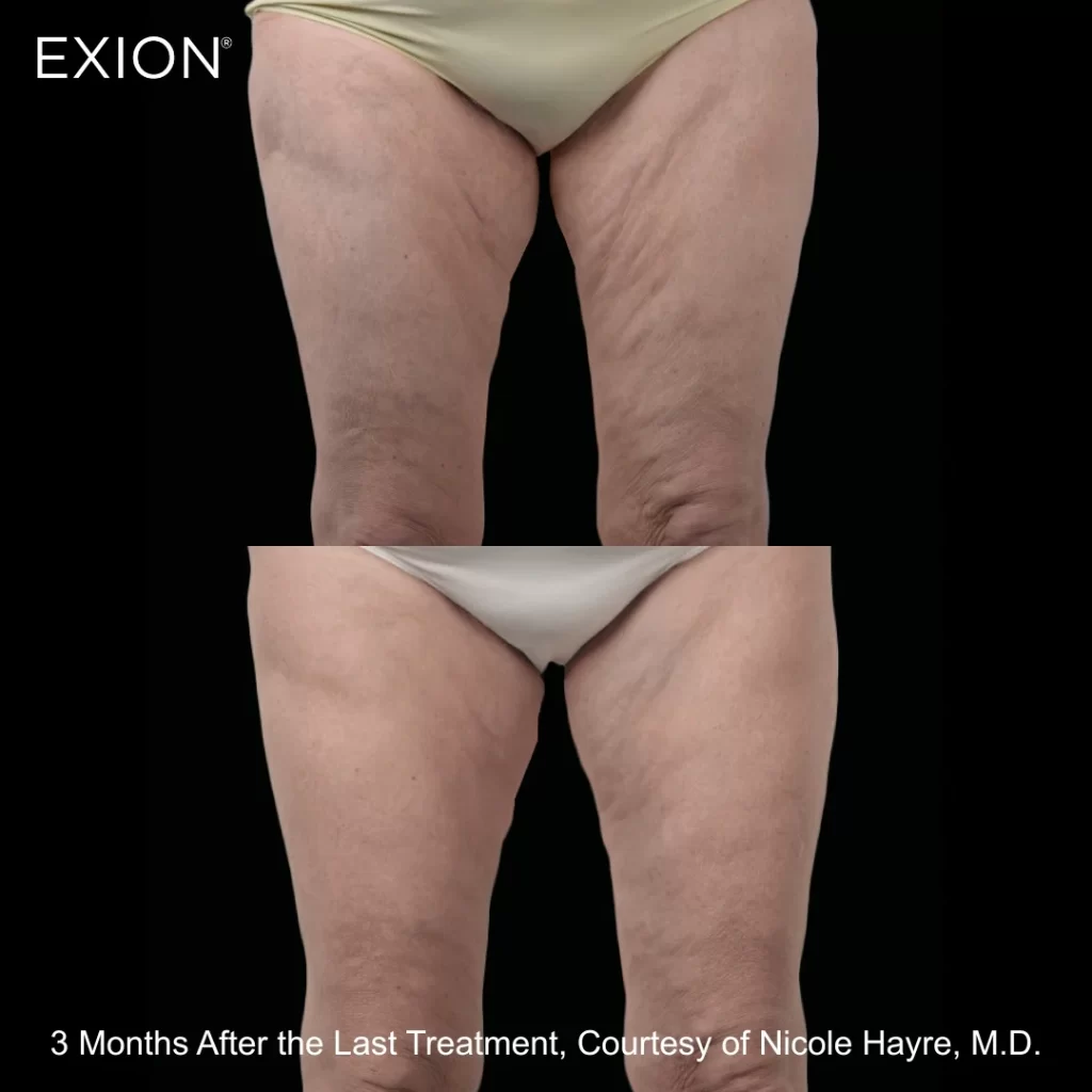 Exion before-and-after results — thighs (female patient)
