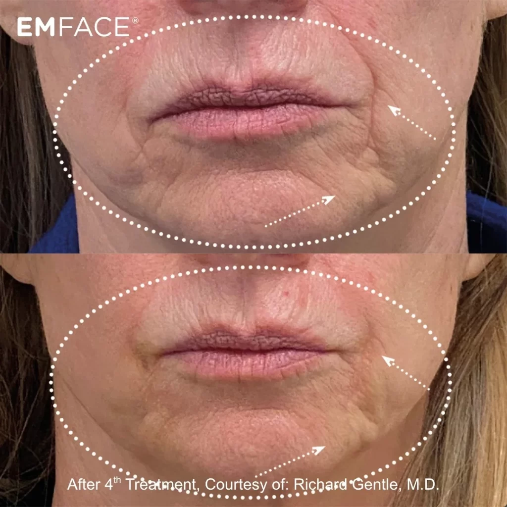 EmFace before-and-after results on the cheeks and mouth area